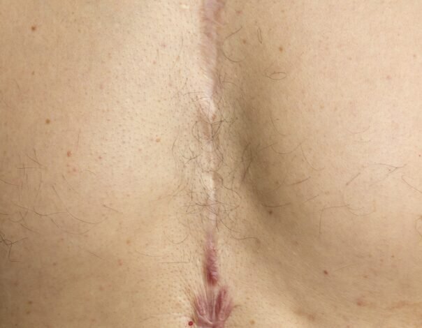 What Breast Augmentation Scars Can I Expect?