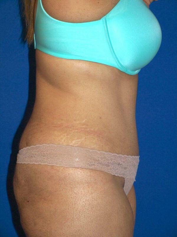 Managing Your Tummy Tuck Scars: Tips and Tricks - Face+Body Cosmetic  Surgery Miami FL