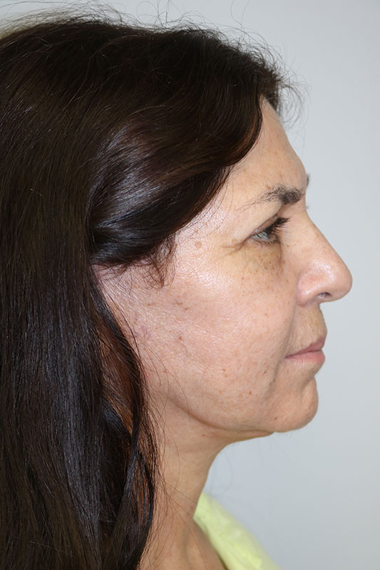 Facelift Before & After Image