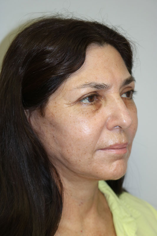 Facelift Before & After Image