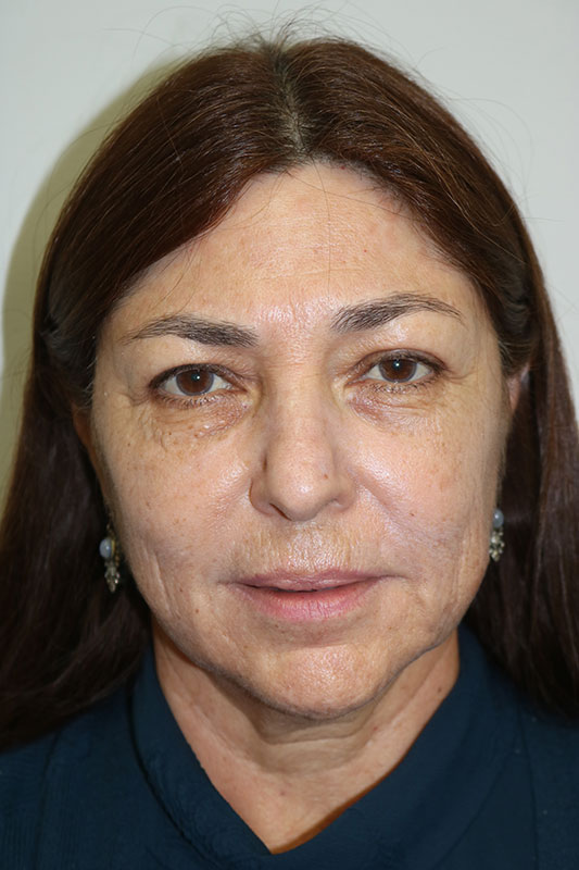 Facelift Before & After Image