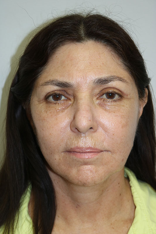 Facelift Before & After Image