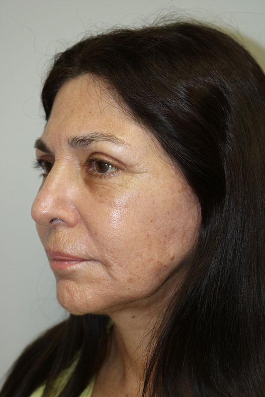 Facelift Before & After Image