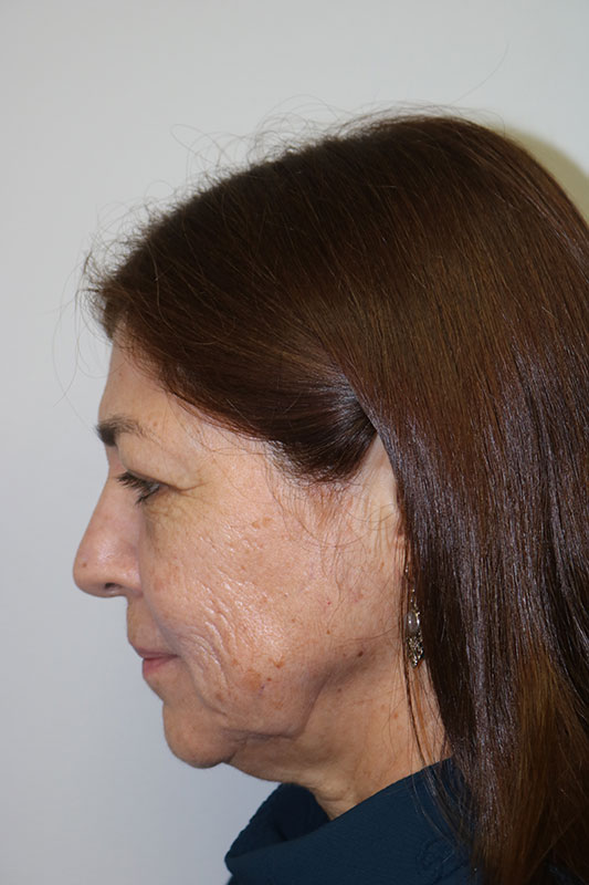 Facelift Before & After Image