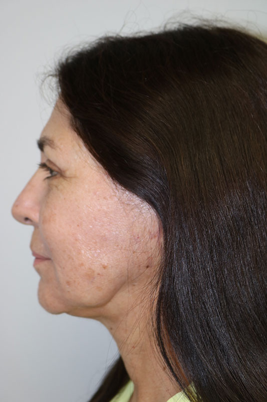 Facelift Before & After Image