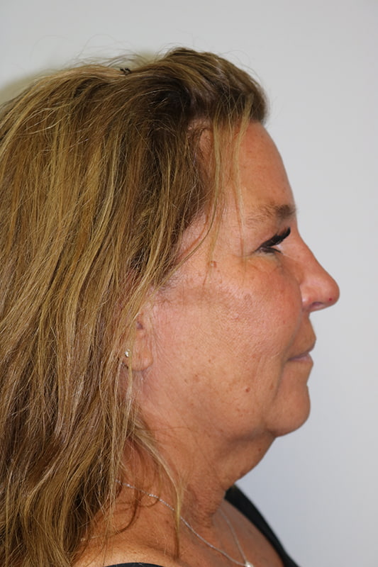 Facelift Before & After Image