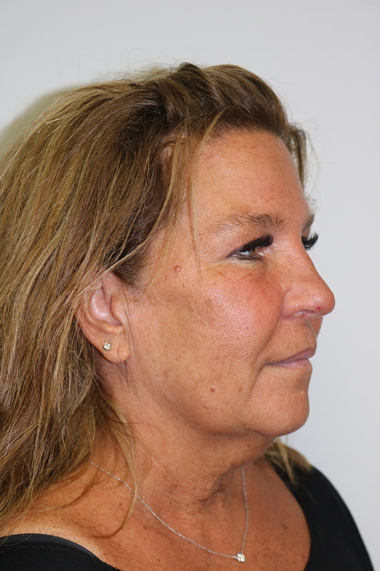 Facelift Before & After Image