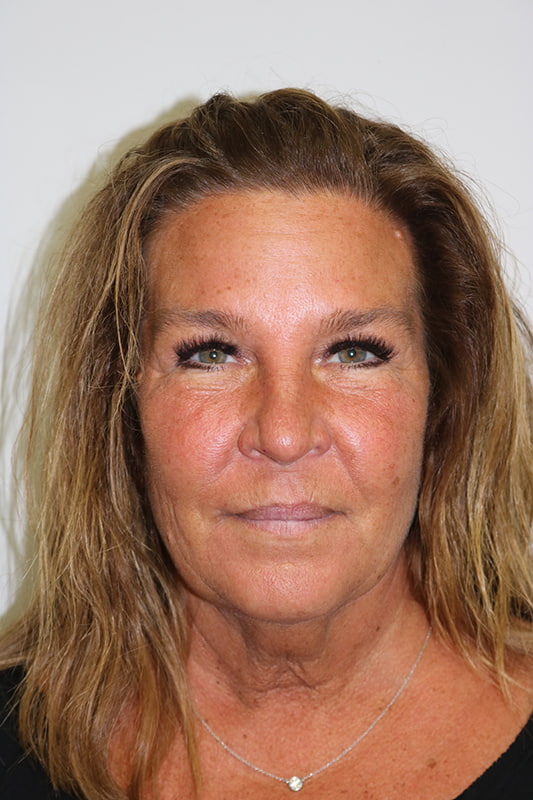 Facelift Before & After Image