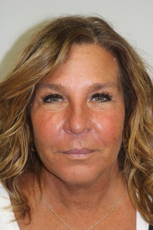 Facelift Before & After Image