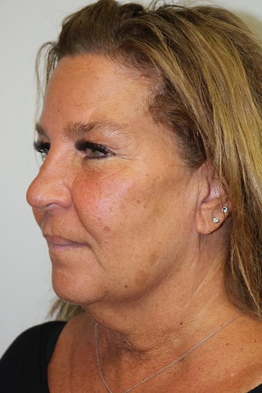 Facelift Before & After Image