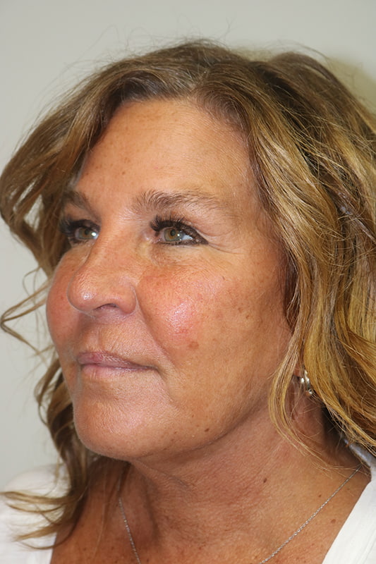 Facelift Before & After Image