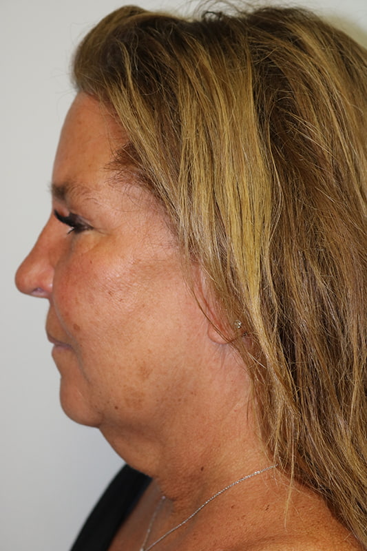 Facelift Before & After Image