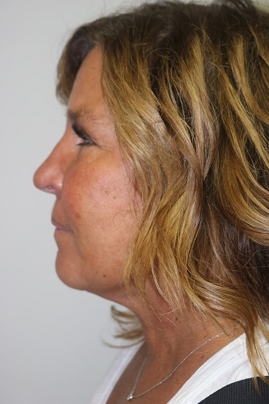 Facelift Before & After Image