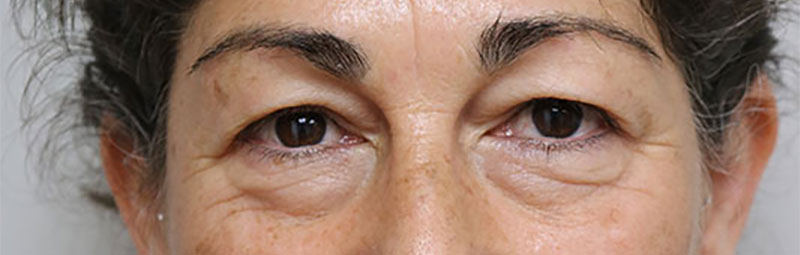 Lower Blepharoplasty Before & After Image