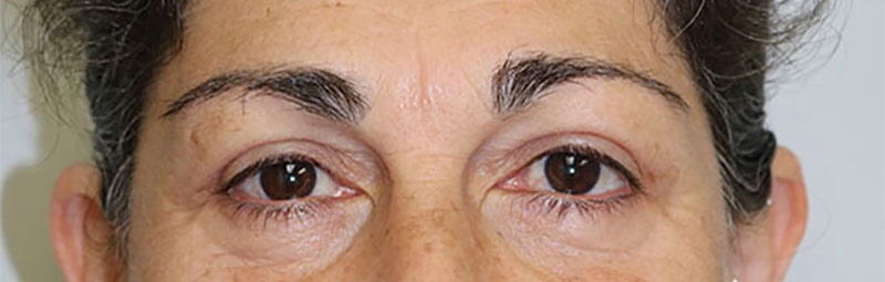 Lower Blepharoplasty Before & After Image