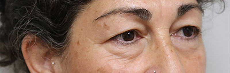 Lower Blepharoplasty Before & After Image