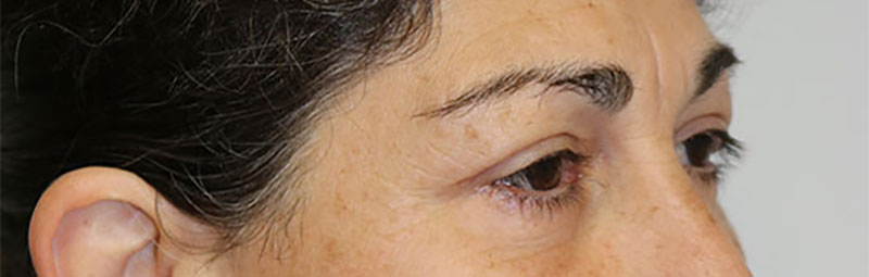 Lower Blepharoplasty Before & After Image