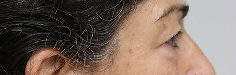 Lower Blepharoplasty Before & After Image