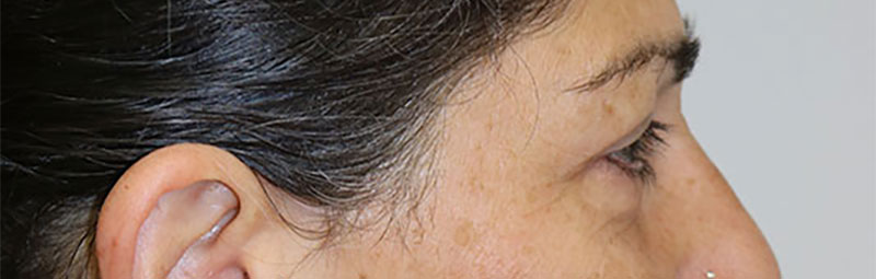 Lower Blepharoplasty Before & After Image