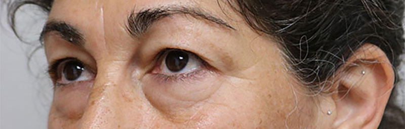 Lower Blepharoplasty Before & After Image