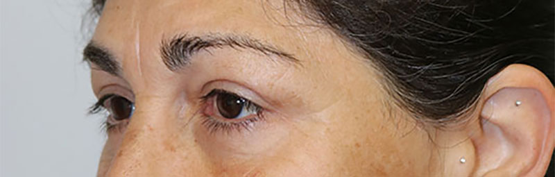 Lower Blepharoplasty Before & After Image