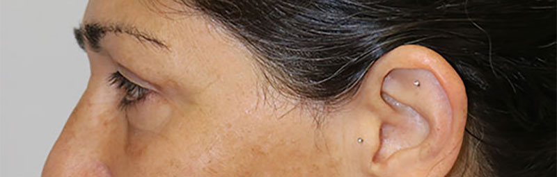 Lower Blepharoplasty Before & After Image