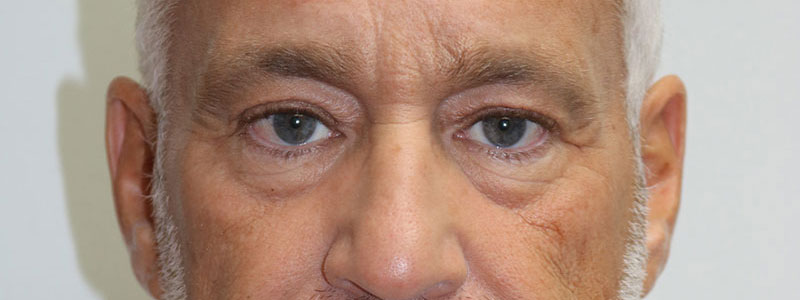 Lower Blepharoplasty Before & After Image