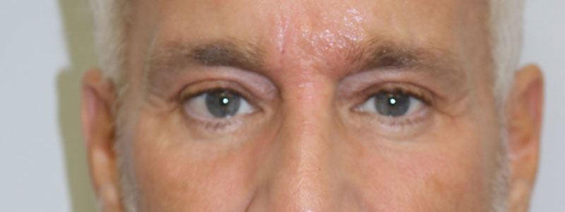 Lower Blepharoplasty Before & After Image