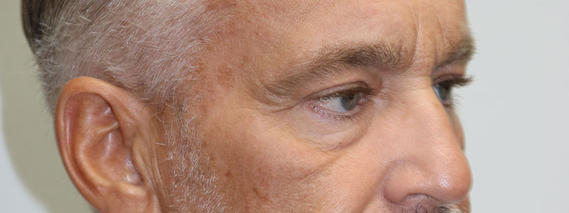 Lower Blepharoplasty Before & After Image