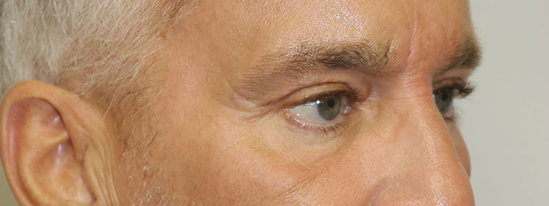 Lower Blepharoplasty Before & After Image