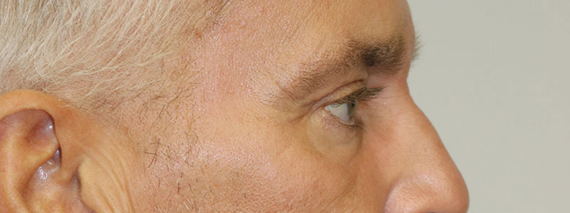 Lower Blepharoplasty Before & After Image