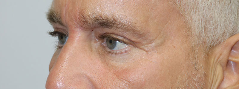 Lower Blepharoplasty Before & After Image