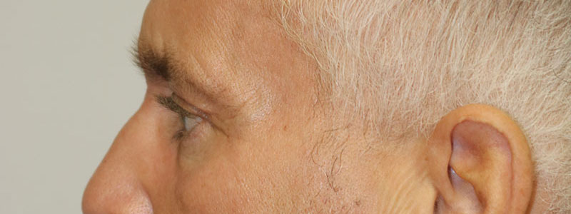 Lower Blepharoplasty Before & After Image