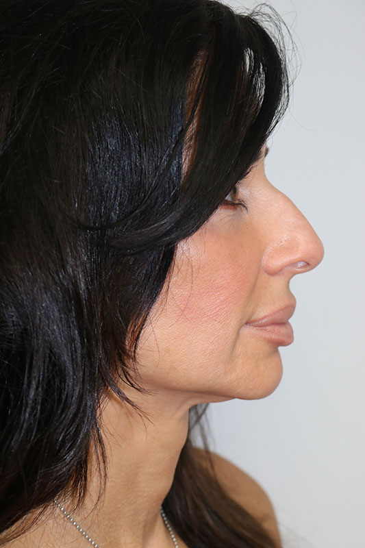 Rhinoplasty Before & After Image