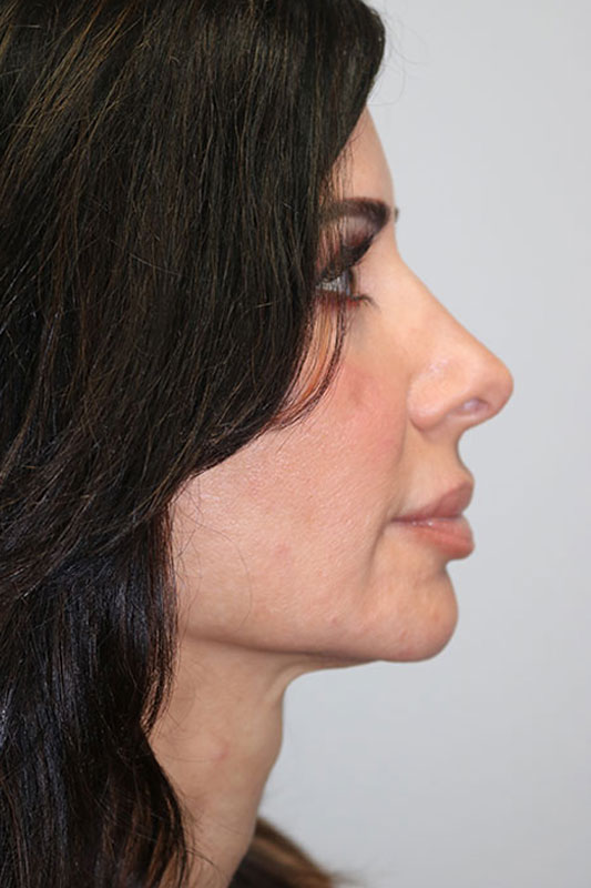 Rhinoplasty Before & After Image