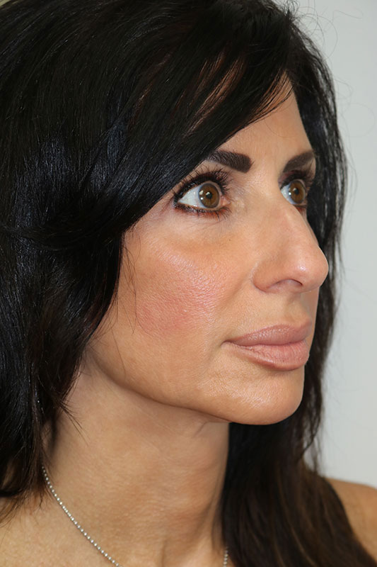 Rhinoplasty Before & After Image