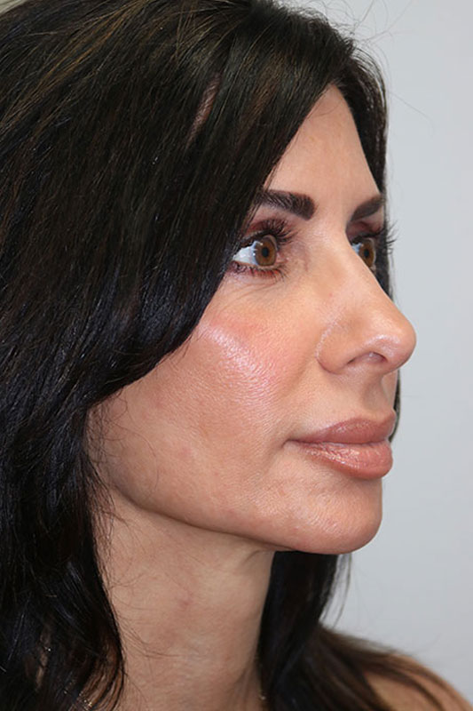 Rhinoplasty Before & After Image