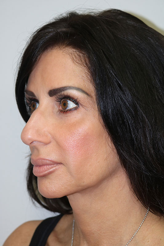 Rhinoplasty Before & After Image