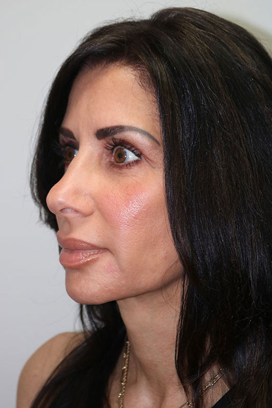 Rhinoplasty Before & After Image