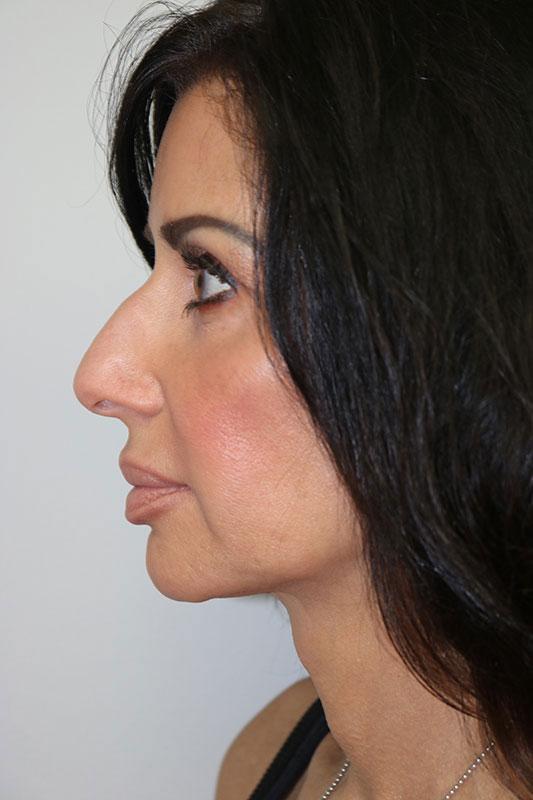 Rhinoplasty Before & After Image