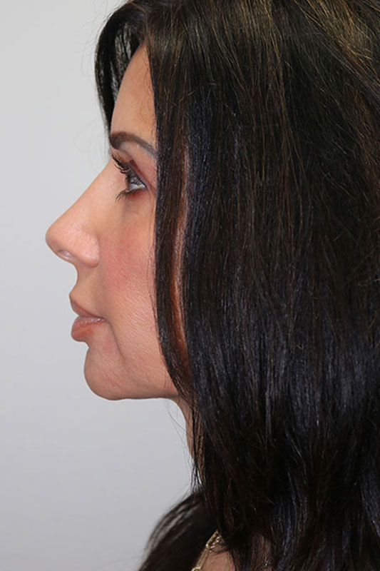 Rhinoplasty Before & After Image